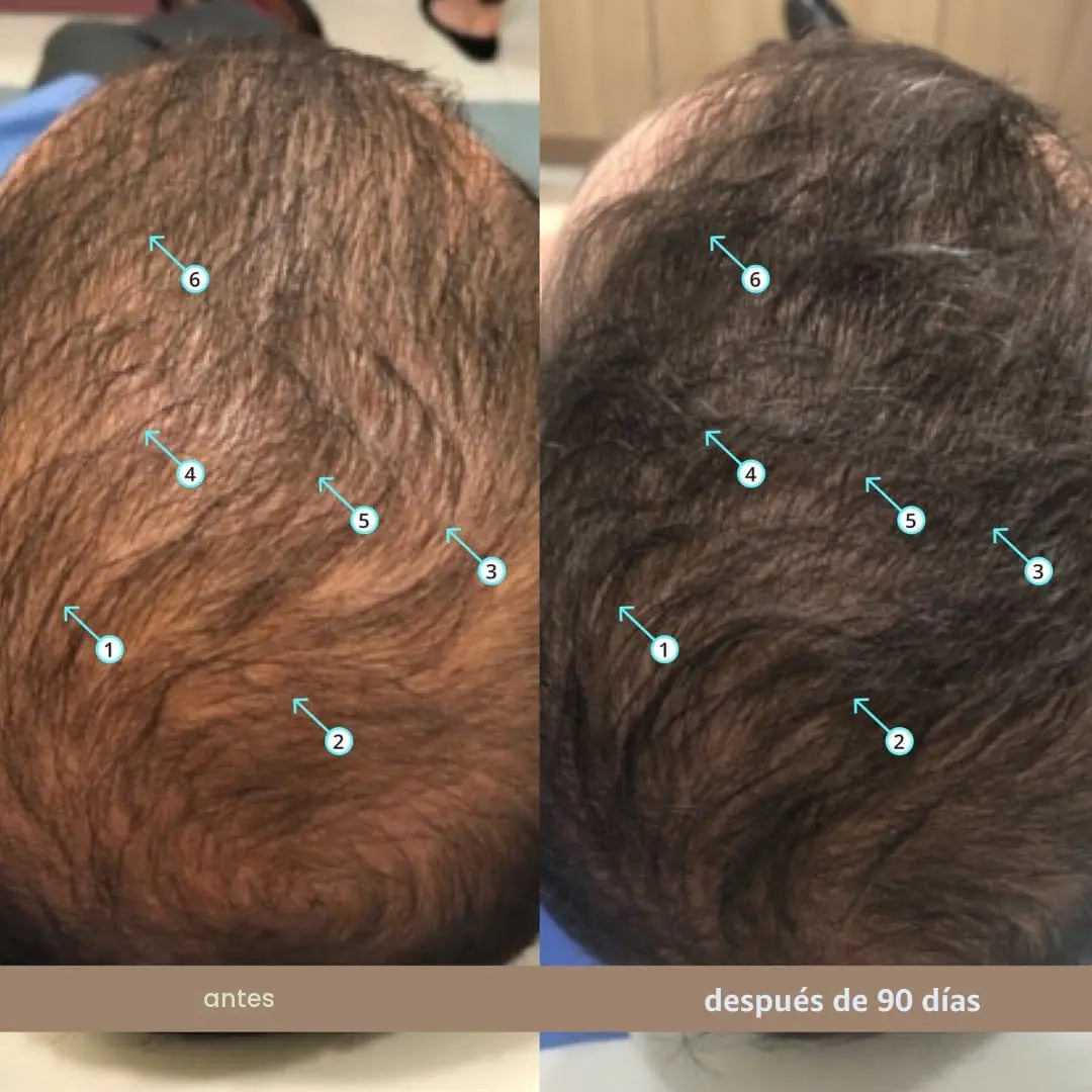 VELORA MEN'S™ Densidad Capilar y Barba | Nanoxidil 5%